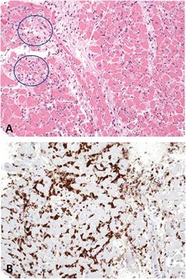 Case Report First-in-Man Method Description: Left Ventricular Unloading With iVAC2L During Veno-Arterial Extracorporeal Membrane Oxygenation: From Veno-Arterial Extracorporeal Membrane Oxygenation to ECMELLA to EC-iVAC®